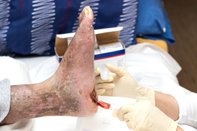 Podiatrist providing medical treatment for a foot ulcer. Podiatrist performing wound care procedure on a patient's foot ulcer.