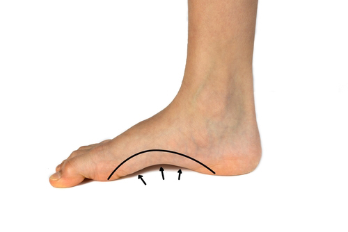 Teenager's high‑arched foot demonstrating elevated medial longitudinal arch Close‑up of a teenage foot with an excessively elevated arch, showing a high‑arch (pes cavus) foot.