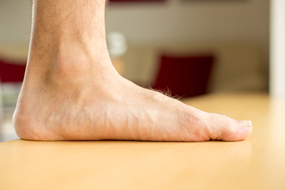 Close-up of foot with collapsed arch showing flat foot deformity.