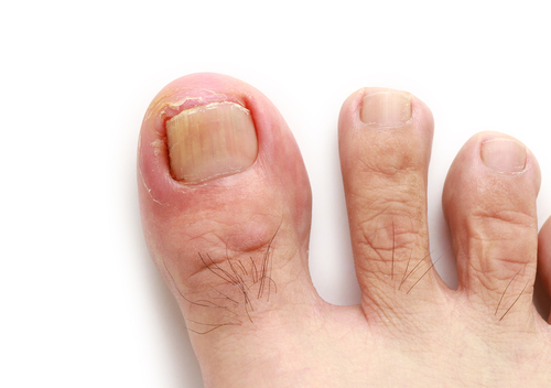Close-up of an inflamed big toe caused by an ingrown toenail.