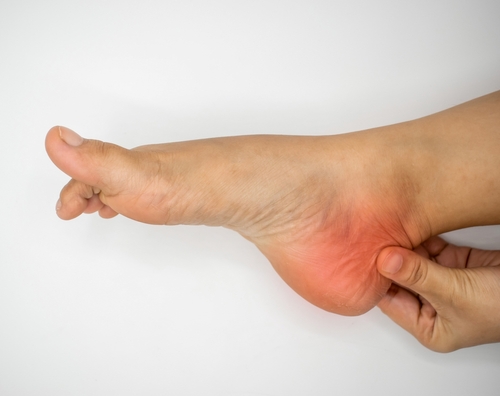Close-up of foot with plantar fasciitis on white background