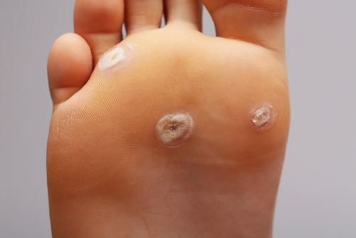 Close-up of plantar warts located on the sole of a patient's foot